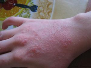 Защо пръстите oblazit кожни причини и описание на възможните заболявания, съвети за грижите за