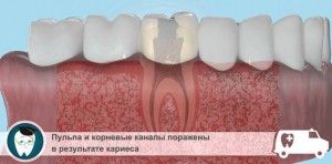 След лечение на пулпит зъбобол и болезнени усложнения nakusyvat