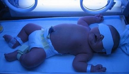 Повишаване на билирубина при новородени причини