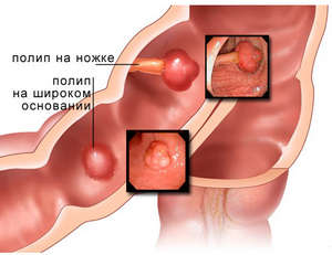 Причините за полипи в жлъчния мехур, diagonstirovanie и лечението на тумори