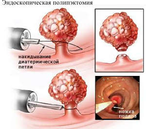 Причините за полипи в жлъчния мехур, diagonstirovanie и лечението на тумори