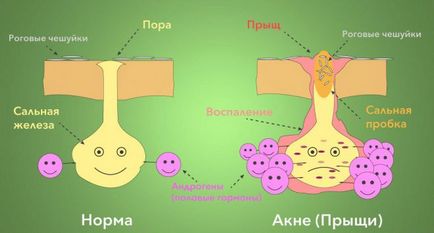 Акнето се дължи на хормони при жените, които вършат това, което анализира, за да предадат