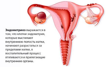 Симптомите на миома на матката в комбинация с ендометриоза, операцията