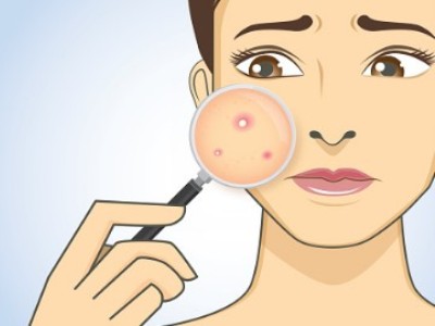 Салициловата киселина и нейното приложение за лицето