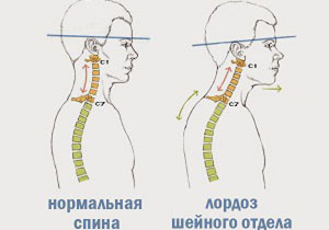 Маточната лордоза се изправи (загладени) - симптоми, причини и лечение на шийните прешлени заболяване