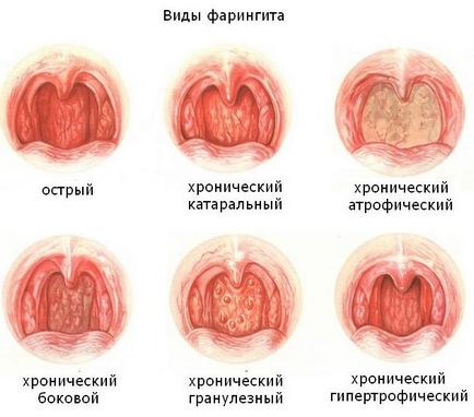 Симптоми и лечение на фарингит при деца остра, вирусни, гранулозотекалните, хронична, снимки