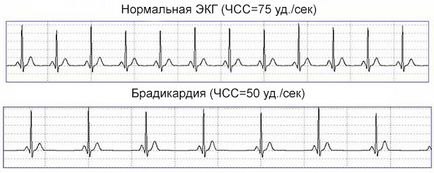 Синусова аритмия на сърцето причинява, диагностика и лечение
