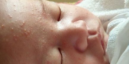 Обрив при новороденото - описание на симптомите, видовете лезии и как да се отървете