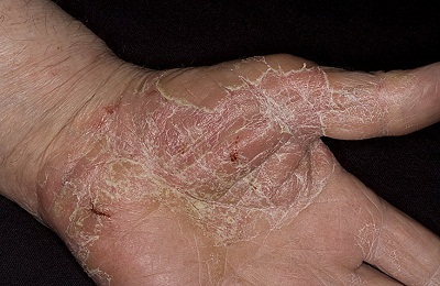 Суха екзема на ръцете, отколкото за лечение на симптомите и причините