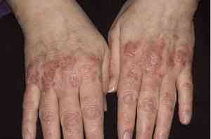 Пукнатини в ръцете на лечението - болестта на кожата - Статии Directory - народни лечебни рецепти