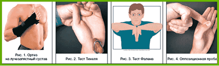 Карпалния тунел синдром симптоми, лечение у дома