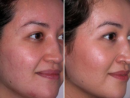 Ултразвуково почистване на лицето преди и след снимки, предимствата и недостатъците на ултразвук, ревюта на пациентите