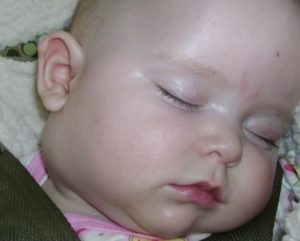 Увеличени лимфни възли в областта на шията на детето симптоми, причини, лечение