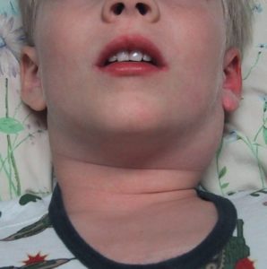 Увеличени лимфни възли в областта на шията на детето симптоми, причини, лечение
