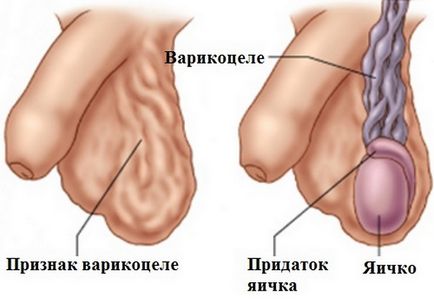 Варикоцеле при мъжете това е, симптоми и лечение