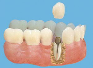 Видове страници на зъба от короната и техните характеристики