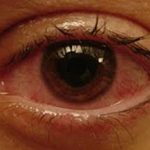 В някои случаи има мъгла в очите на началната лечение на очите