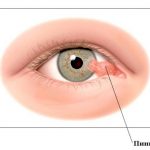 В някои случаи има мъгла в очите на началната лечение на очите