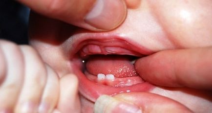 В какъв ред и как да растат зъби при децата