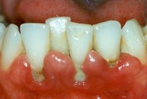 Заболяване на венците какво да прави и как да се отнасяме