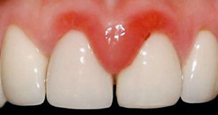 Възпаление на венците около зъба води, лечение, профилактика