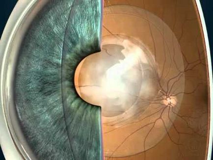Средно катаракта след подмяна на пречиствателни обектив, диагностика, симптомите