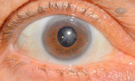 Средно катаракта симптоми, причини, лечение и профилактика на вторични катаракти