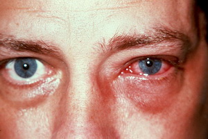 Химическа око изгаряния първа помощ за химически изгаряния на роговицата, окото за лечение на изгаряния