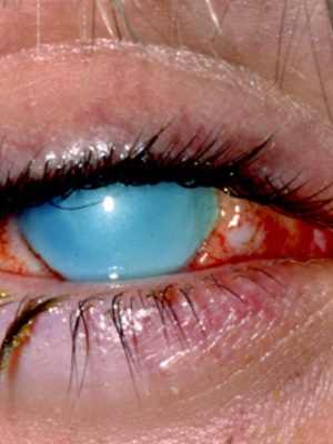 Химическа око изгаряния първа помощ за химически изгаряния на роговицата, окото за лечение на изгаряния