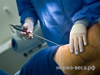 Хирургично лечение на затлъстяване, което е бариатрична хирургия