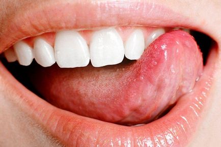 Язви по езика - от лечението, причините, за рани по езика на детето