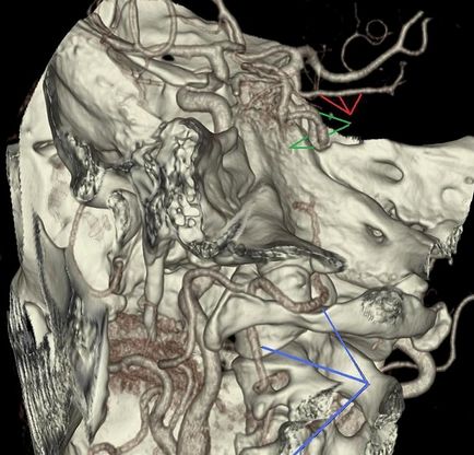Задна (отпред) трифуркация на дясната вътрешна каротидна артерия, че е