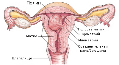 Влакнести жлезиста ендометриален полип диагностиката и лечението