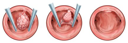 Жлезна-влакнести полип endometriya- всичко, което трябва да знаете за него