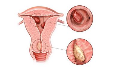 Жлезна-влакнести полип endometriya- всичко, което трябва да знаете за него