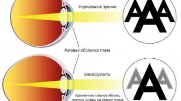 Vision минус 1, което означава, село визия за това какво да правя, рязко защо, от компютър, късогледство