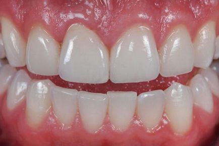 Зъби керамичен описание, характеристики, производство и ревюта