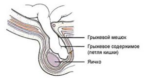 Какво е херния тестис