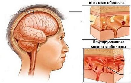 Какво е гноен менингит