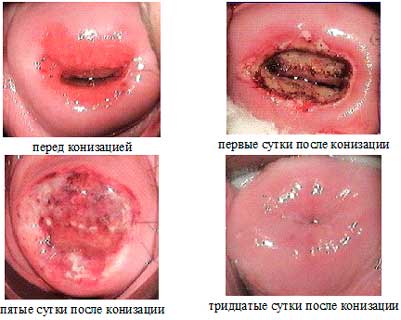 conization какво е