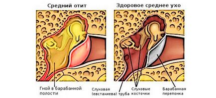 Лечение на възпаление на средното ухо деца вкъщи