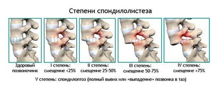 Как да се намали прешлен