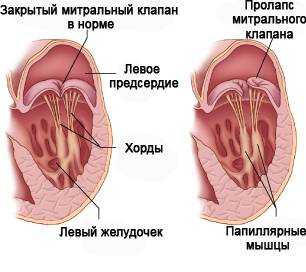 Пролапс на сърцето, че е