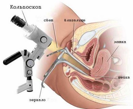 Какво е радио вълни коагулация