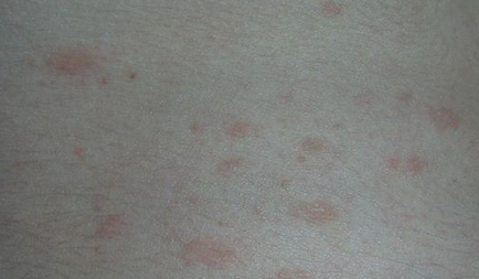 Обриви по тялото на възрастен видове, снимка, лечение, кожни заболявания