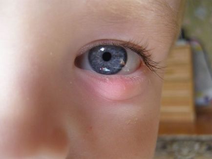 Chalazion лечение на дете