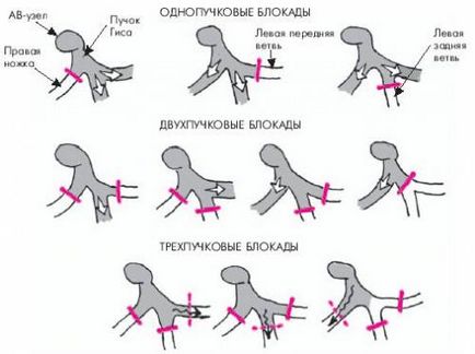 Какво е непълен сърдечен блок