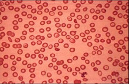Червените кръвни клетки в урината, това означава в норма и отклонение