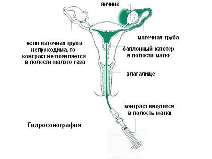 Salpingography какво е