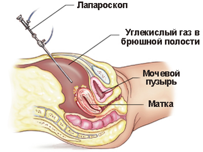 Какво е лапароскопия матката